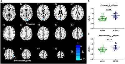 Altered local and remote functional connectivity in mild Alzheimer’s disease patients with sleep disturbances